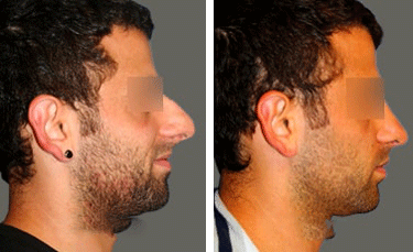Rhinoplasty before after results lahore pakistan