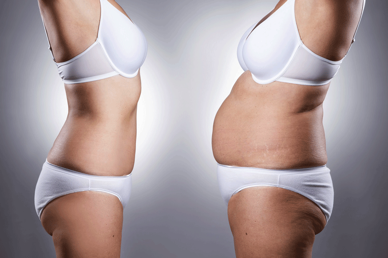 Why Should You Opt for Tummy Tuck Procedure in Houston?