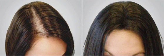 PRP Hair Treatment In Lahore Pakistan | Best Results -
