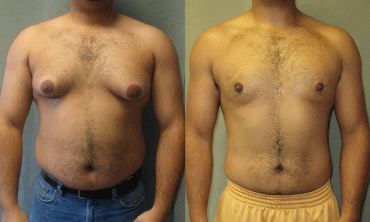 WHY TO CHOOSE LAFORMA CLINIC SERVICES FOR GYNECOMASTIA SURGERY IN LAHORE PAKISTAN