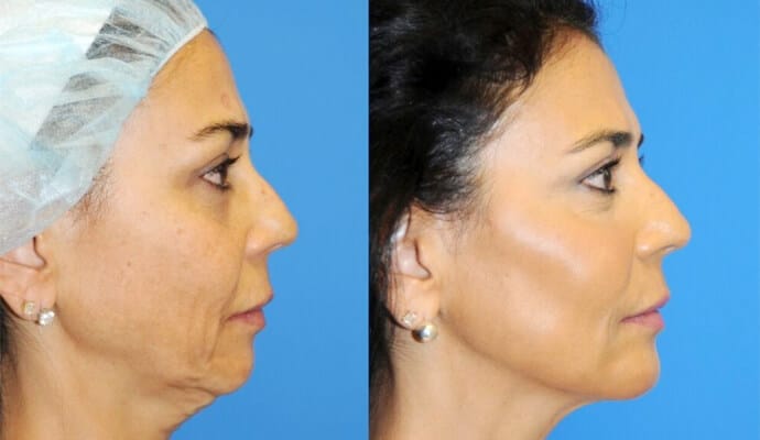 Facelift and Necklift article surgery in lahore