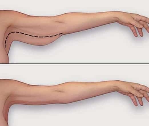 WHAT IS ARM REDUCTION SURGERY OR ARM LIFT SURGERY