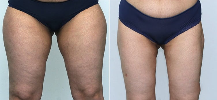 THIGH LIFT SURGERY IN LAHORE PAKISTAN