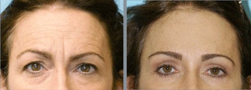 brow lift surgery in lahore pakistan