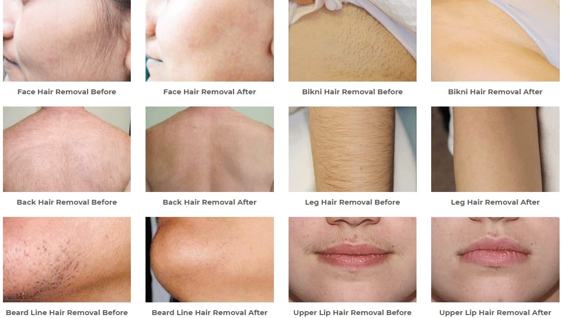 Best Lazer Hair Removal in Lahore