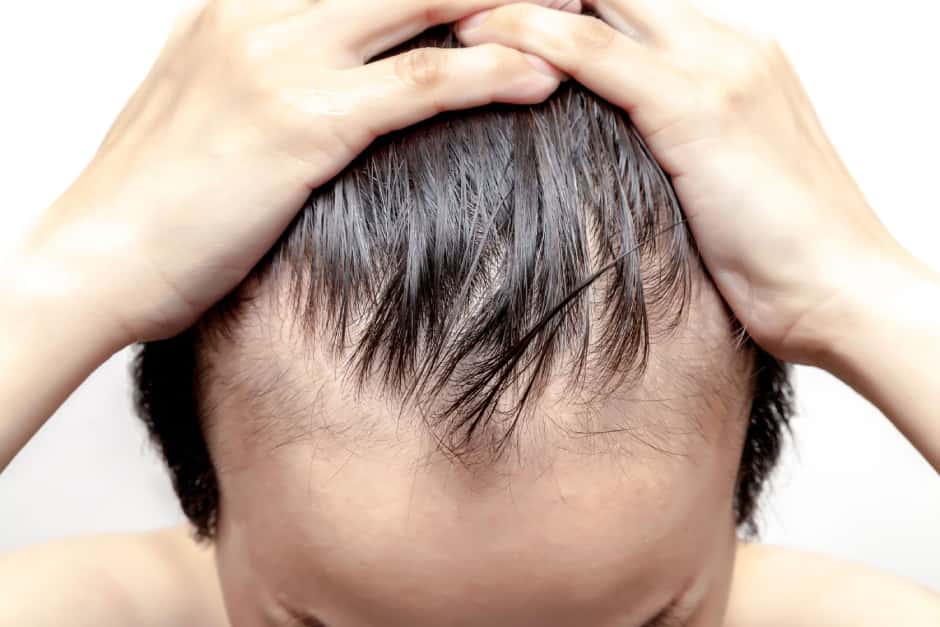 Losing Hair at 25 Male Treatment