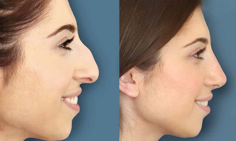 What is Nose Rhinoplasty