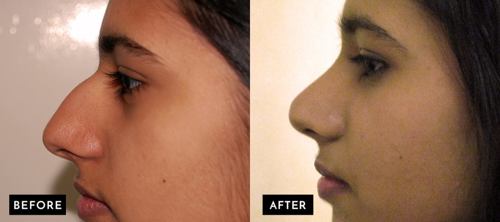 rhinoplasty girl image before and after