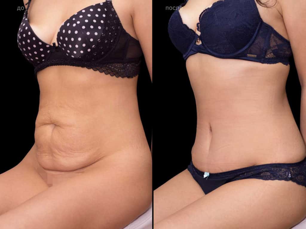 A cosmetic surgical process to improve the appearance of the tummy is known...
