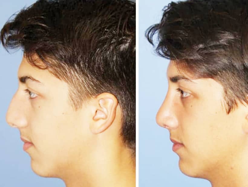 Benefits of Male Nose Surgery