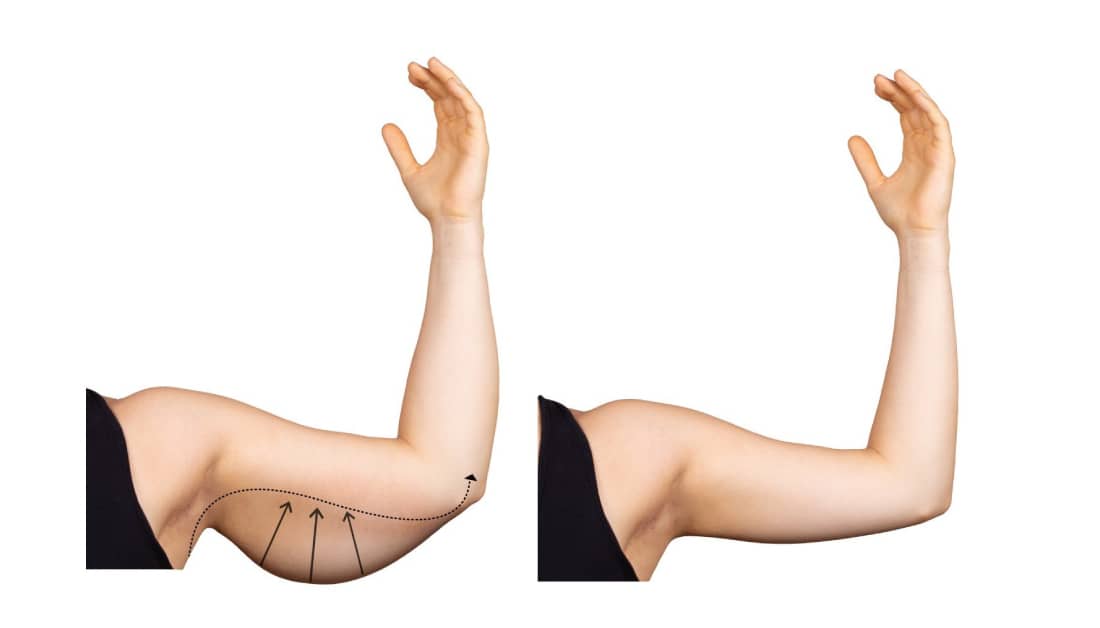 Arm Lift Surgery vs Arm Liposuction