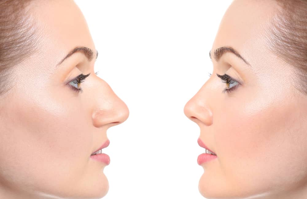 What makes a beautiful nose Rhinoplasty in Lahore