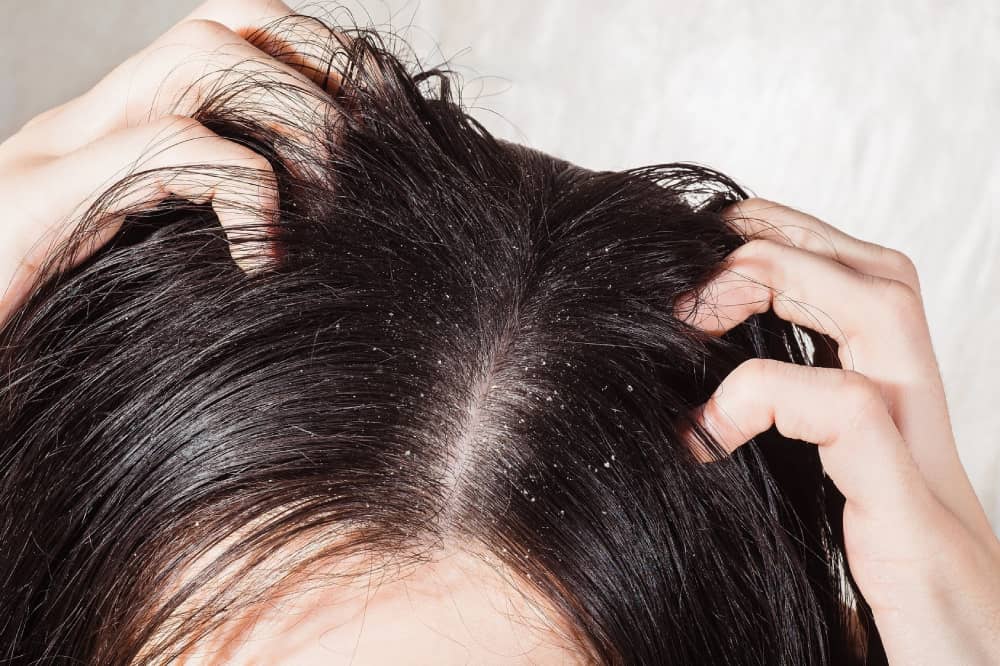 How do You Get Rid of Oily Scalp Naturally