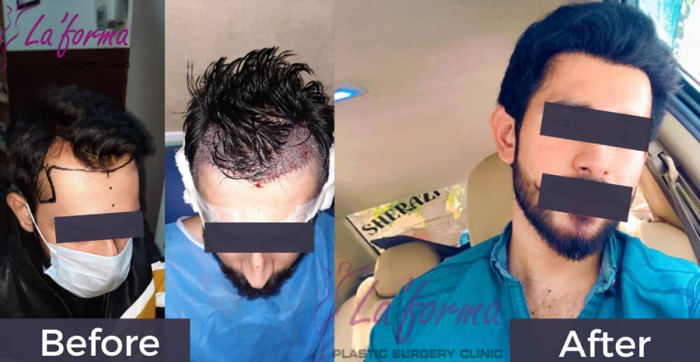 best fue without head shave hair transplant in pakistan and lahore