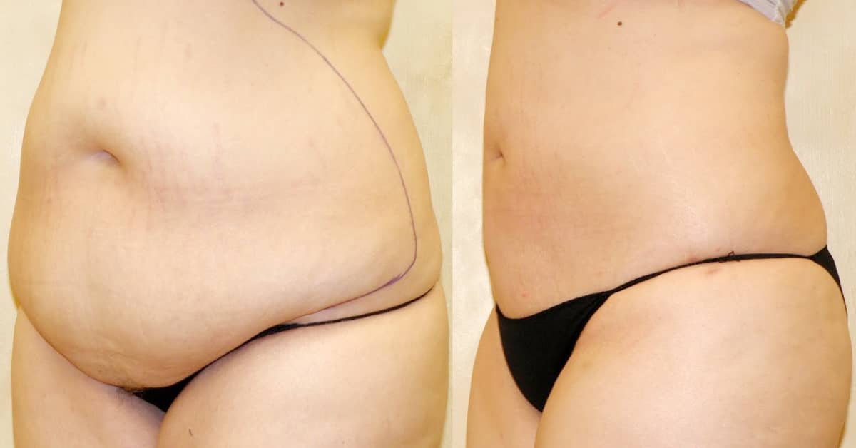 Will liposuction help me lose weight