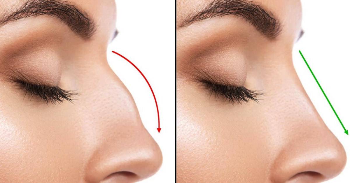 What to Expect after 3 Weeks Rhinoplasty