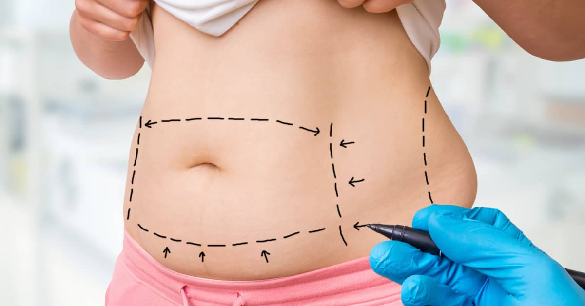 Things You Need to Know About Liposuction