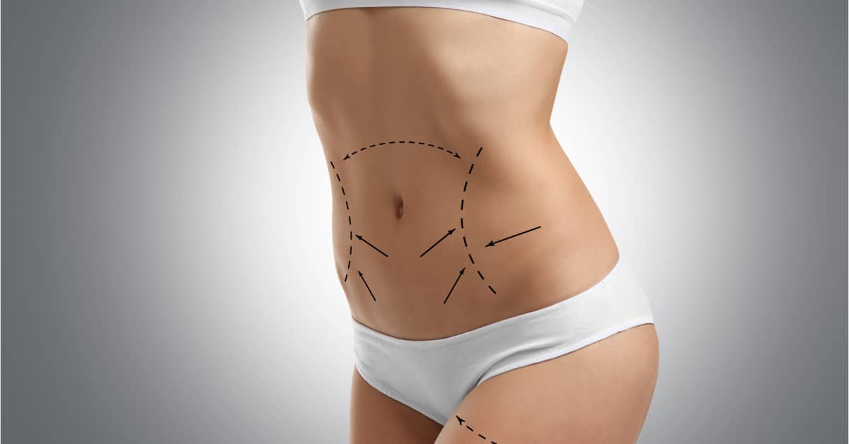 Areas of the Body Liposuction Can Treat