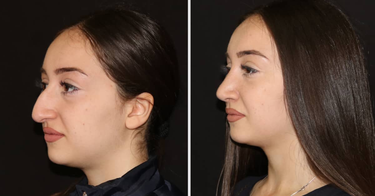 Rhinoplasty Nose surgery Nose Reshaping Cosmetic procedures