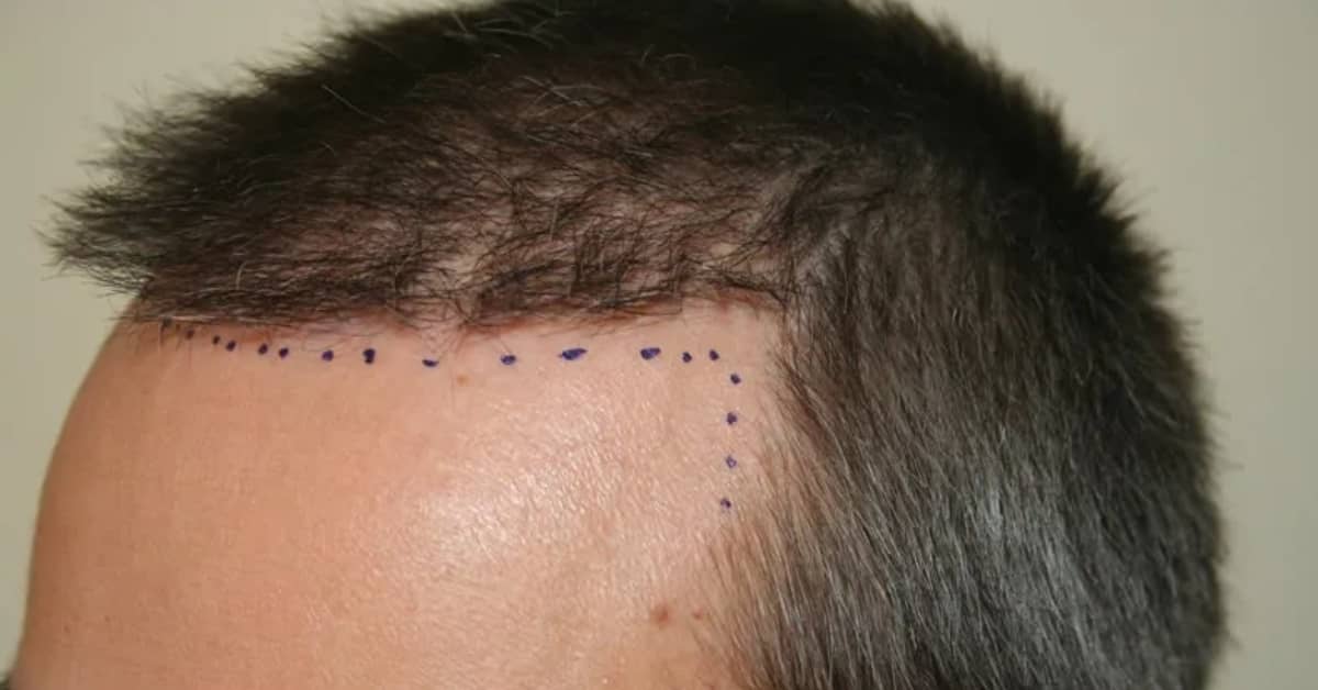 Which Age is Best for Hair Transplant? -