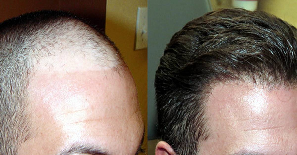How to Increase Hair Density After Hair Transplant? -