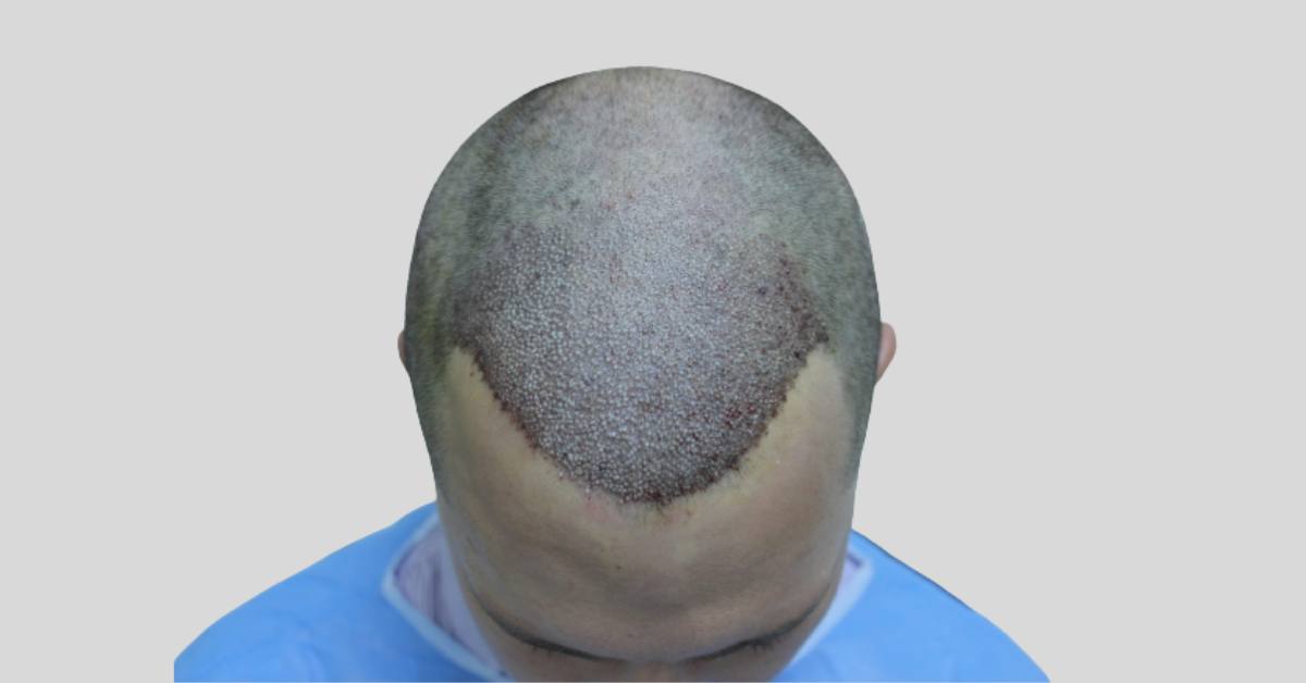How Does Hair Transplant Work_