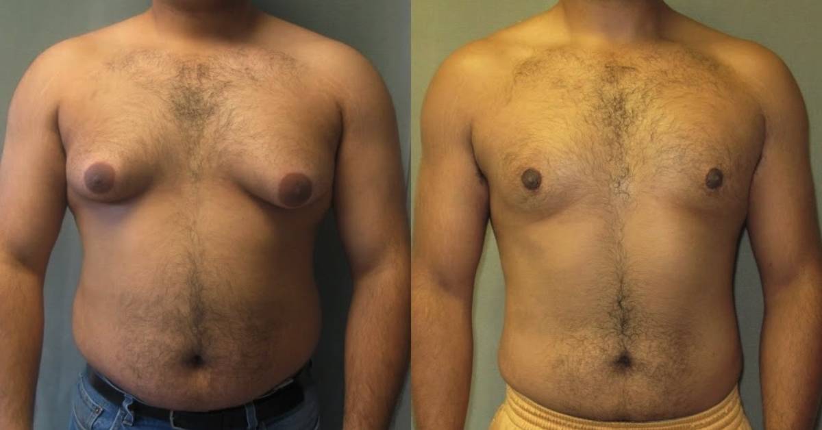 How to Know if You Have Gynecomastia
