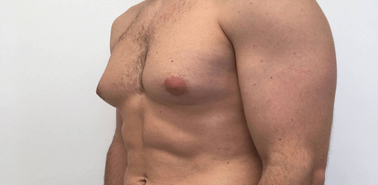 What Men Should Know Before Having Gynecomastia Surgery