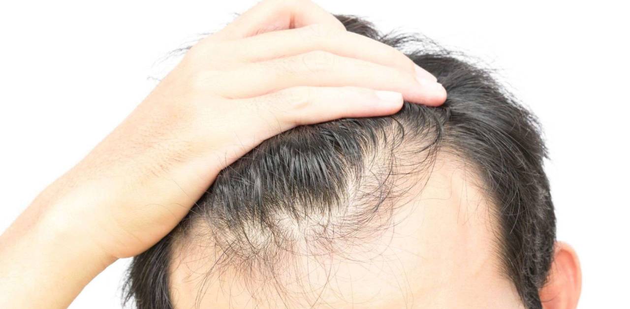 Can Hair Transplant Be Done on Thinning Hair