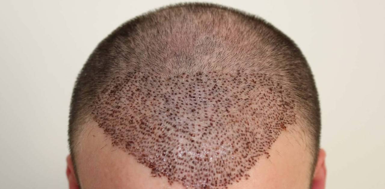 Which Season is Better for Hair Transplant_