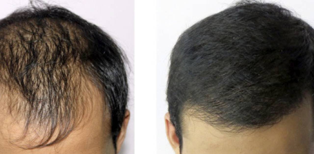 How Long After Hair Transplant Can I Take a Normal Shower_