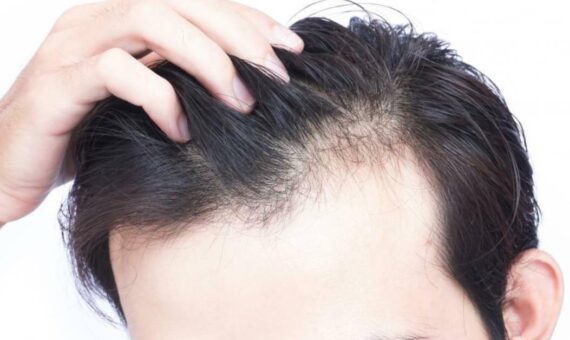 Which vitamin deficiency causes hair loss_