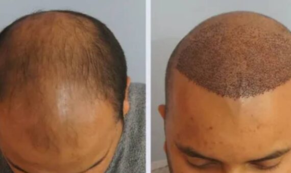 Do You Need to Take Minoxidil After a Hair Transplant_