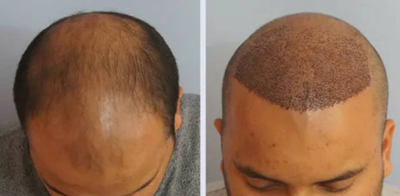 Do You Need to Take Minoxidil After a Hair Transplant_