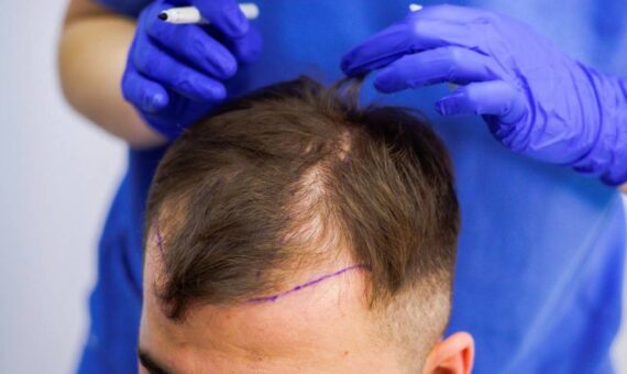 A Comprehensive Guide on How to Prepare for Hair Transplant Surgery